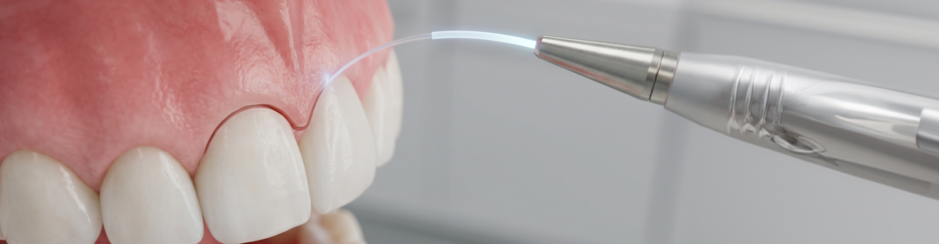Close-up of laser gum contouring to reshape the gumline and enhance the appearance of the smile.